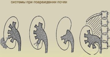 Деформация члс почек