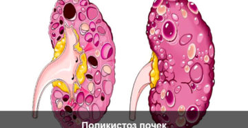Кто рожал с поликистозом почек