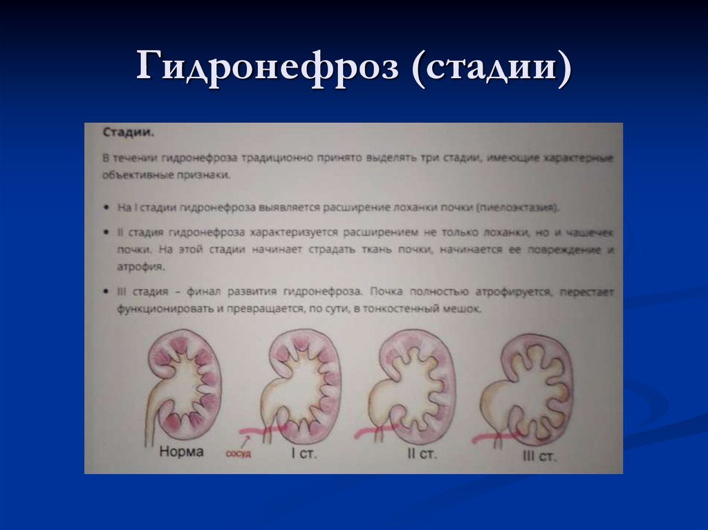 Гидронефроз почки 1 степени что это