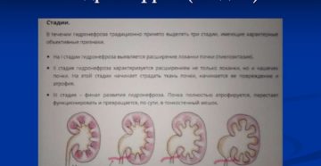 Гидронефроз почки 1 степени что это