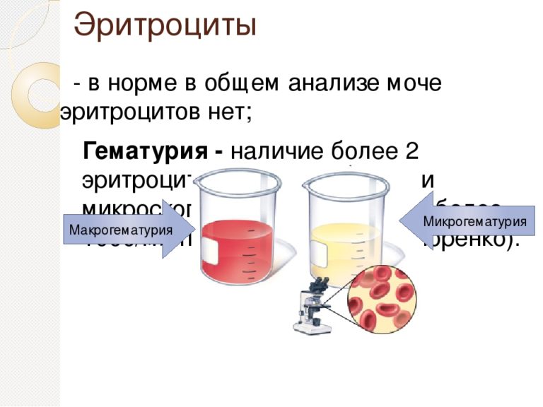 Что такое повышенные эритроциты в моче. Микрогематурия норма эритроцитов в моче. гематурия показатели оам. общий анализ мочи норма эритроцитов в моче. показатель 4 эритроцитов в моче.