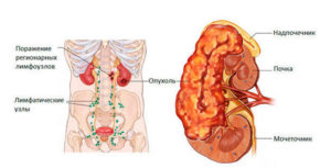 Увеличены лимфоузлы почек