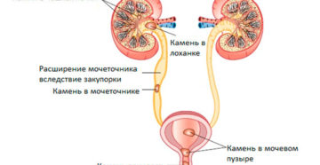 Схема мочеполовой системы у мужчин где появляются камни в почках