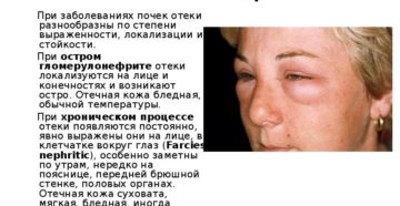 Отечный синдром при заболеваниях почек