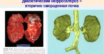 Чем поддержать почки при диабете
