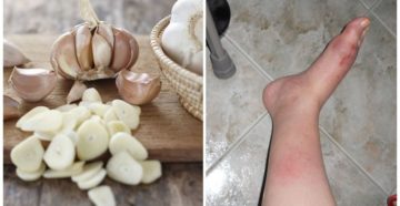 Можно ли лечить почки чесноком