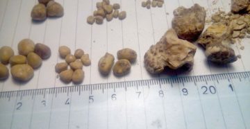 Какие камни в почках растворяются медикаментозно