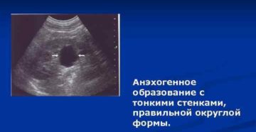 Что такое анэхогенное образование в почках