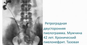 Ретроградная урография при пиелонефрите
