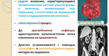 Мультикистоз почек плода