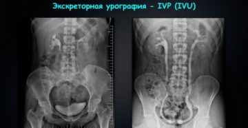 Выделительная урография почек