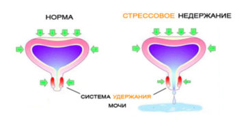 Недержание мочи от смеха у девочки