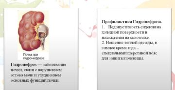 Гидронефроз почек лечение в москве