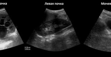 Микрокалькулез левой почки