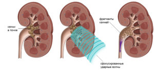 Камни в правой почке что делать