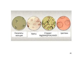 Оксалаты и струвиты разница