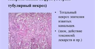 Тубулярный некроз почки
