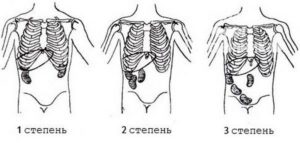 Опущение почки 1 2 степени