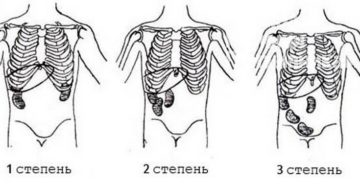 Опущение почки 1 2 степени