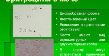 Почему повышены эритроциты в моче у женщины