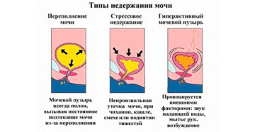 Недержание мочи при смехе у девочки 11 лет