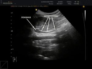 Узи мочеточника у женщин