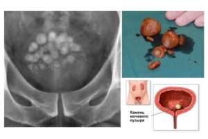 Камни в мочевом пузыре симптомы у мужчин