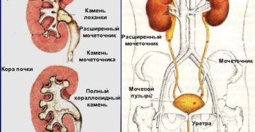Блокировка почки камнем