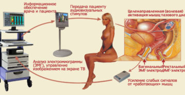 Физиолечение при недержании мочи