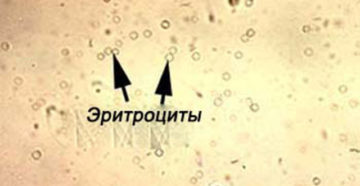 Эритроциты в моче 10 у женщины