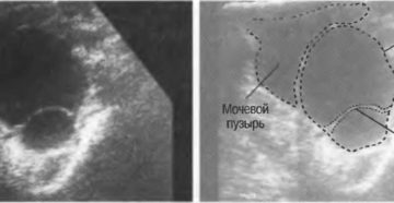 Киста мочевого пузыря симптомы у женщин