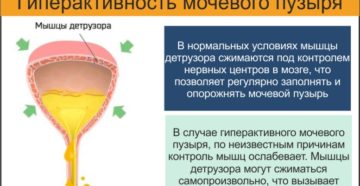 Реактивный мочевой пузырь симптомы лечение