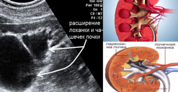 Увеличенная лоханка почки у новорожденного последствия