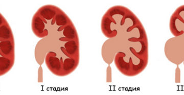 Почки увеличение лоханки причины
