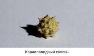 Камни в почках коралловый клуб