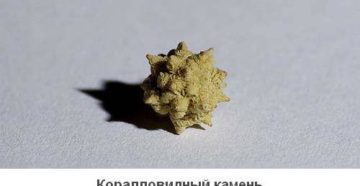Камни в почках коралловый клуб