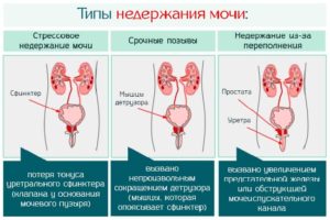 Недержание мочи при химиотерапии