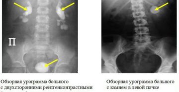 Обзорная флюорография почек