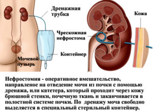 Сколько можно ходить с нефростомой в почке