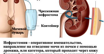 Сколько можно ходить с нефростомой в почке
