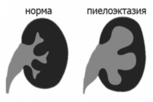 Эхопризнаки пиелоэктазии левой почки у грудного ребенка