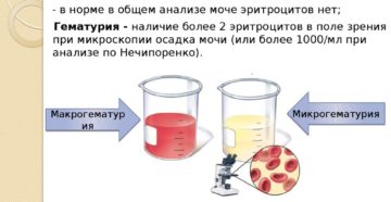 Повышены эритроциты в моче у женщины