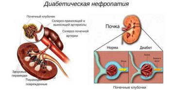 Нефропатия почек симптомы лечение