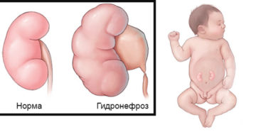 Гидронефроз левой почки у новорожденного лечение