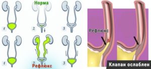 Рефлюкс мочевого пузыря у детей лечение