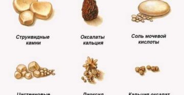 Виды камней в почках