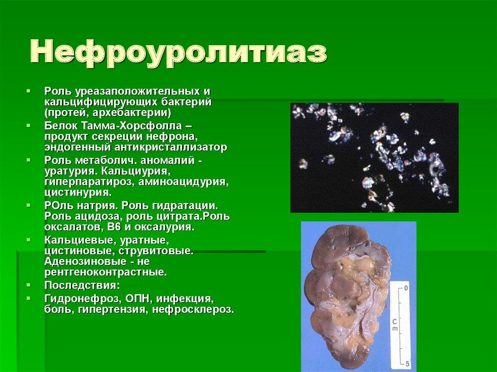 Нефроуролитиаз что это