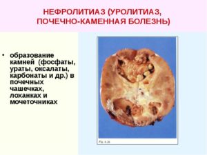 Нефролитиаз обеих почек