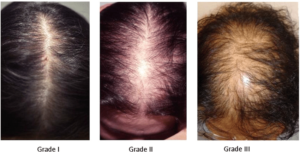 Кортизол и выпадение волос