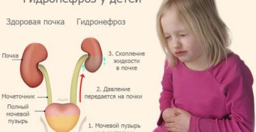 Врожденный гидронефроз у детей